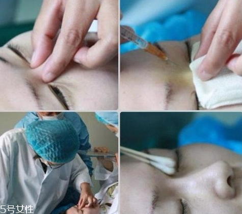 玻尿酸隆鼻維持時間受什么影響？玻尿酸不能過度注射