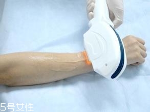 激光脫毛需要幾次？激光脫毛并不是終身有效的
