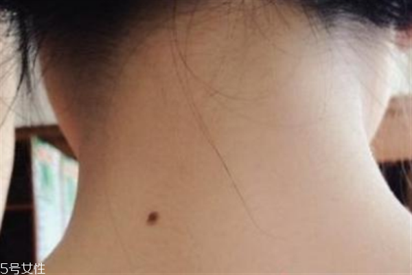脖子后面有痣好嗎？激光冷凍祛痣易導(dǎo)致癌變