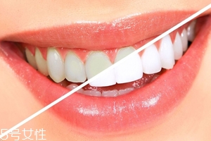 牙齒發(fā)黃是天生的嗎？只是你刷牙偷懶了