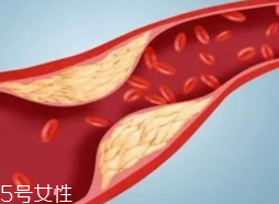 血管堵塞怎么自查？腿腳告訴你答案