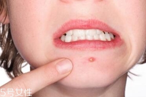 肌膚需要排毒嗎？長痘并不代表排毒