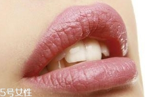 冬天爛嘴角什么原因？有可能營養(yǎng)不良