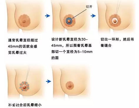 乳暈縮小術怎么做？乳暈縮小術知識全解