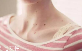 色素痣是腫瘤嗎？良性腫瘤不必?fù)?dān)心