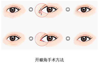 開(kāi)眼角疤痕多久消失？開(kāi)眼角的適宜人群