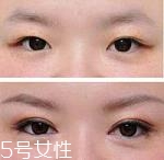 開(kāi)眼角疤痕多久消失？開(kāi)眼角的適宜人群