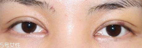 怎么縮短開(kāi)眼角疤痕消失時(shí)間？雙眼皮開(kāi)眼角恢復(fù)過(guò)程