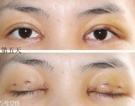 怎么縮短開(kāi)眼角疤痕消失時(shí)間？雙眼皮開(kāi)眼角恢復(fù)過(guò)程