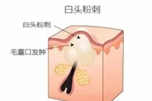閉口是怎么引起的？4種情況要注意
