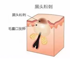 閉口是怎么引起的？4種情況要注意
