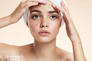 痘痘反復長是什么原因？基礎護膚不夠用心