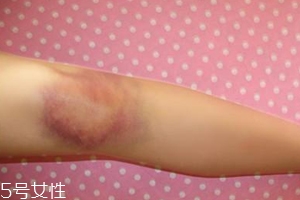 身體淤青怎么來的？不是磕碰那么簡單