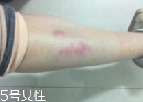 身體淤青怎么來的？不是磕碰那么簡單