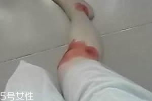 摔傷了涂什么藥好的快？做好消毒才能愈合快