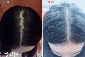 柳屋生發(fā)水有用嗎？一個月后長出新發(fā)