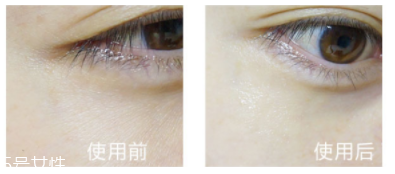 shangpree香蒲麗眼膜適合多大年齡？任何年齡