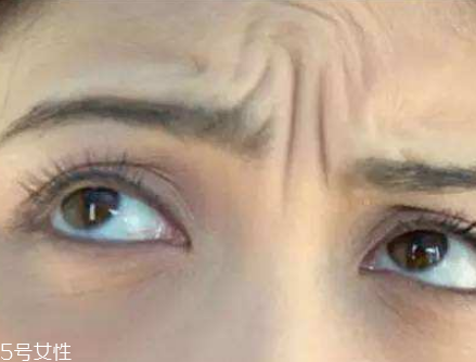 川字紋可以手術(shù)去除嗎？選擇手術(shù)需謹(jǐn)慎