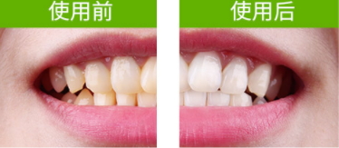 牙貼怎么分上下牙貼？牙貼怎么分正反