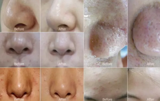 弄完小氣泡多久可以化妝？小氣泡注意事項(xiàng)