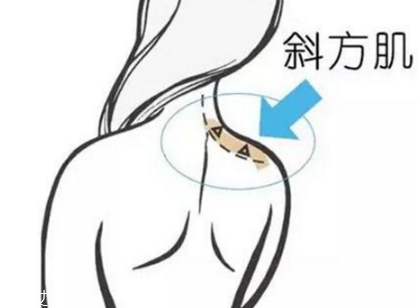 瘦肩針間隔多久打一次？打瘦肩針間隔時(shí)間