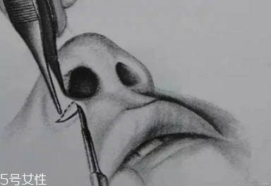 鼻翼外切多久消腫？鼻翼外切消腫時(shí)間要多長(zhǎng)？