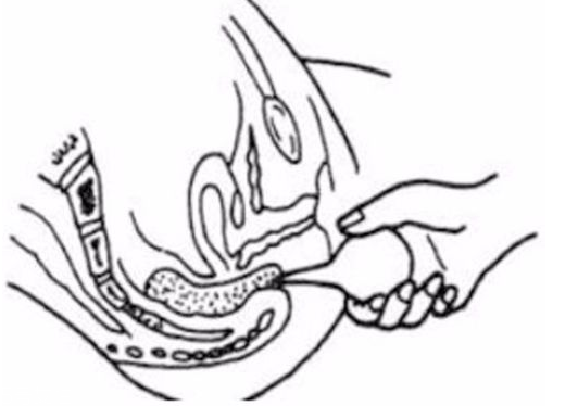 開(kāi)塞露躺著還是蹲著用？開(kāi)塞露使用姿勢(shì)