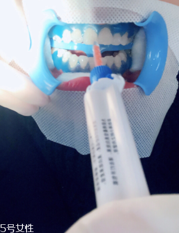 冷光美白會(huì)反彈嗎？冷光美白心得