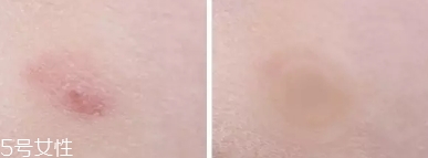vt痘痘貼怎么用？vt老虎痘痘貼防水嗎