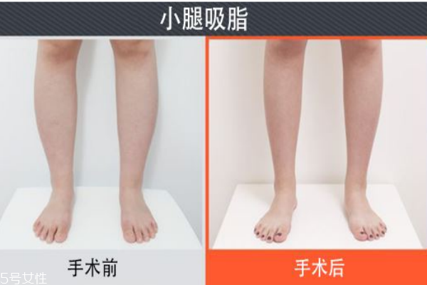 小腿吸脂后遺癥你知道多少？