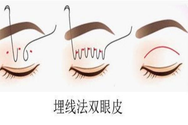 埋線雙眼皮感染怎么辦？埋線雙眼皮發(fā)炎了怎么辦