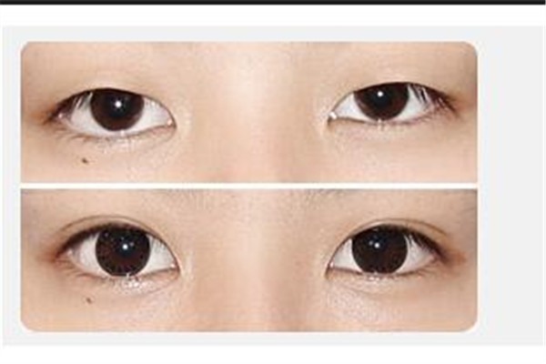 韓式雙眼皮手術(shù)多少錢(qián) 做雙眼皮手術(shù)多少錢(qián)