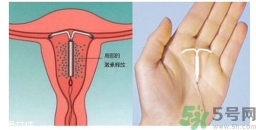 上環(huán)是什么意思？上環(huán)后注意事項有哪些？