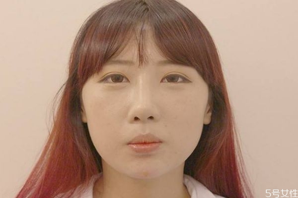 墊下巴的手術(shù)需要多久恢復呢 墊下巴有什么缺點呢