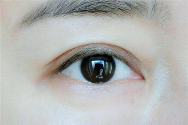 重瞼修復(fù)術(shù)是什么 重瞼修復(fù)術(shù)術(shù)前要準備什么