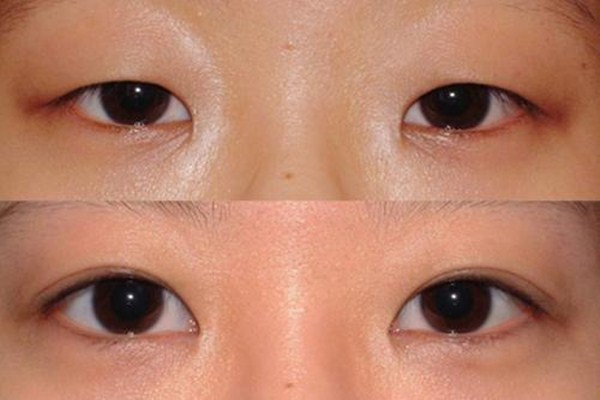 重瞼修復(fù)術(shù)是什么 重瞼修復(fù)術(shù)術(shù)前要準備什么