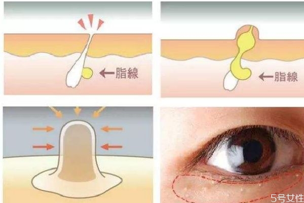 脂肪粒是怎么形成的呢 脂肪?？梢宰约汉脝?></p><h3>脂肪?？梢宰约汉脝?/h3><p>很多人都有長(zhǎng)脂肪粒的煩惱，但是卻并不是所有長(zhǎng)脂肪粒的人都知道要怎么去去除它們，還有很多女生覺得，脂肪粒長(zhǎng)了就長(zhǎng)了，沒必要去搭理它們，過段時(shí)間之后皮膚就會(huì)自動(dòng)的把它們的消滅了。雖說(shuō)，我們每一個(gè)人的皮膚確實(shí)有自我修復(fù)的作用，有一部分脂肪粒也確實(shí)可以在一定的時(shí)間內(nèi)被我們自身的調(diào)節(jié)機(jī)制去除，但是大部分人長(zhǎng)的脂肪粒，并不會(huì)在時(shí)光里被治愈，而是在漫長(zhǎng)的歲月里，一直停留在你臉上，為你的形象減分。</p><p style=