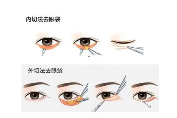 去眼袋手術(shù)費(fèi)用大概多少錢(qián) 去眼袋手術(shù)有危害嗎