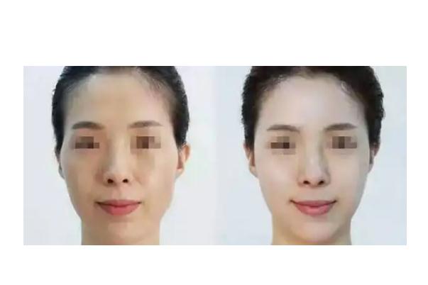 童顏針會(huì)凹凸不平嗎 童顏針對身體有害嗎