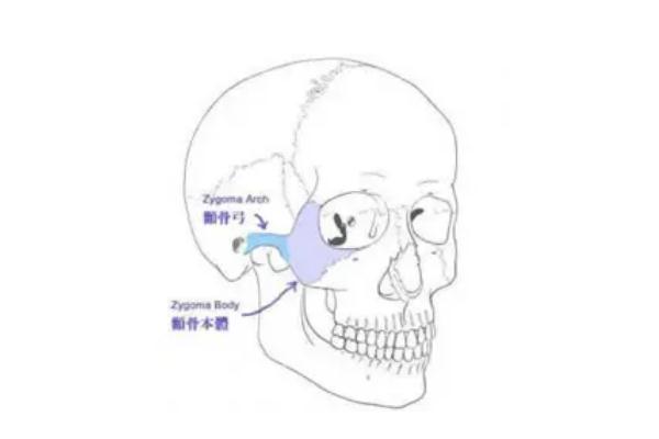 顴骨內(nèi)推手術多少錢啊 顴骨內(nèi)推后遺癥