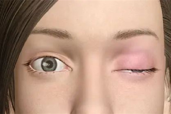 武漢上眼瞼下垂哪個醫(yī)院做的好 武漢上眼瞼下垂修復手術要多少錢